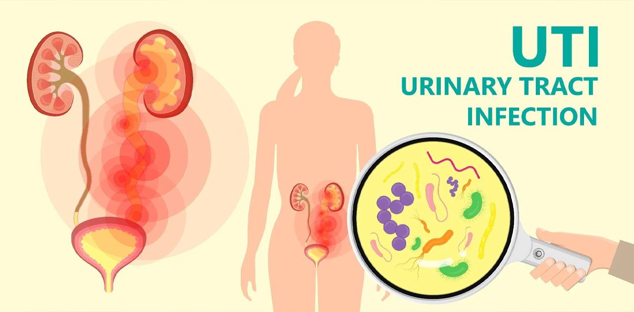 केटीहरू सजिलै UTI को शिकार हुन सक्छन्, यसबाट बच्न के गर्ने?