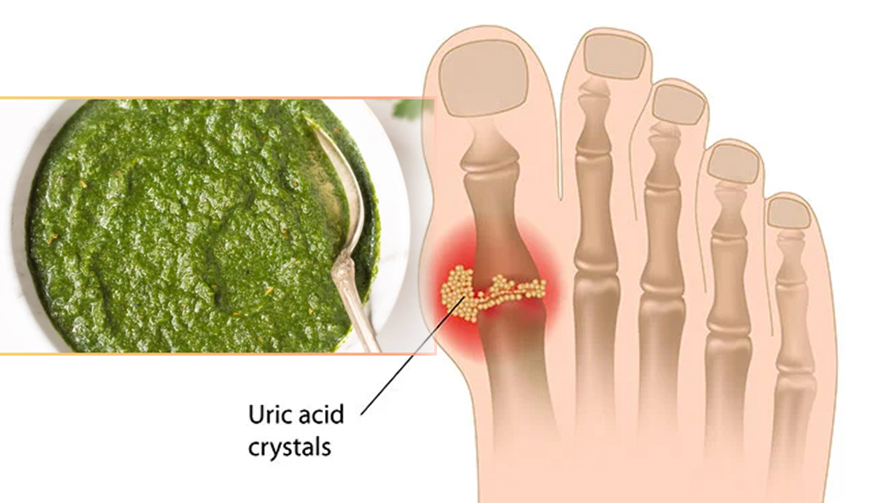 उच्च युरिक एसिड भएकाले खानुहोस् यो चटनी